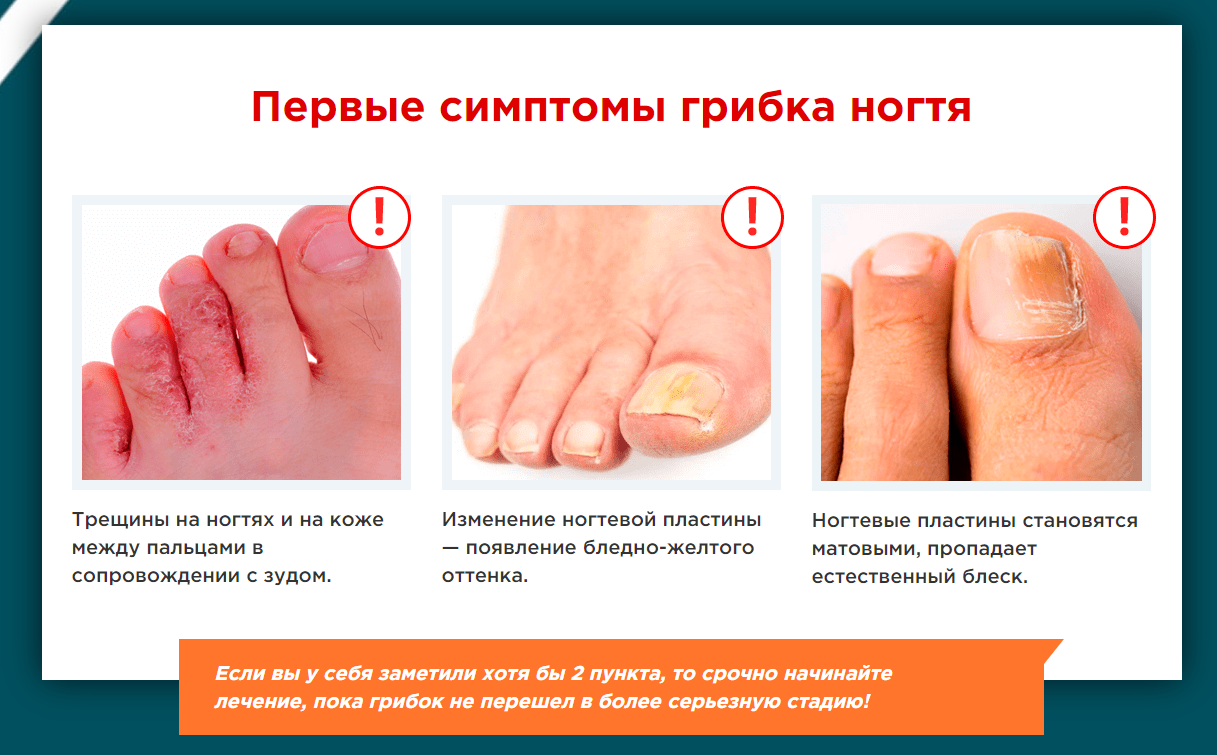 Симптомы грибка ногтей